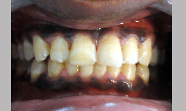 Root canal treatment in Anand
                        